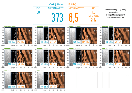 FibroScan