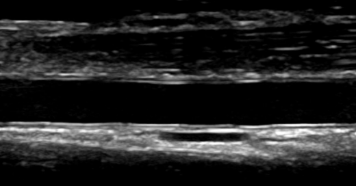 Advancing Liver Disease Research with Transient Elastography