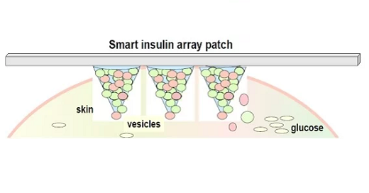 Smart Insulin Patches or Glucose-Responsive Insulin Delivery Systems